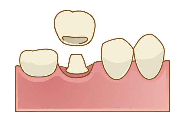 被せ物(クラウン)