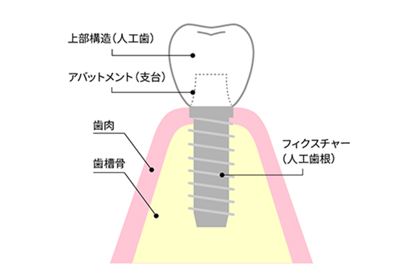 インプラント