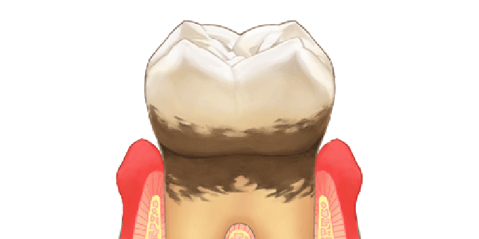 軽度歯周病