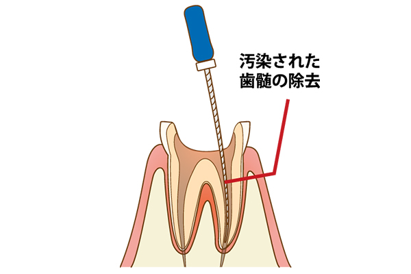 根管治療